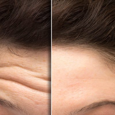 face of a woman before and after a botox treatment to smooth expression lines. Concept of anti-aging and rejuvenation cosmetics on forehead wrinkles
