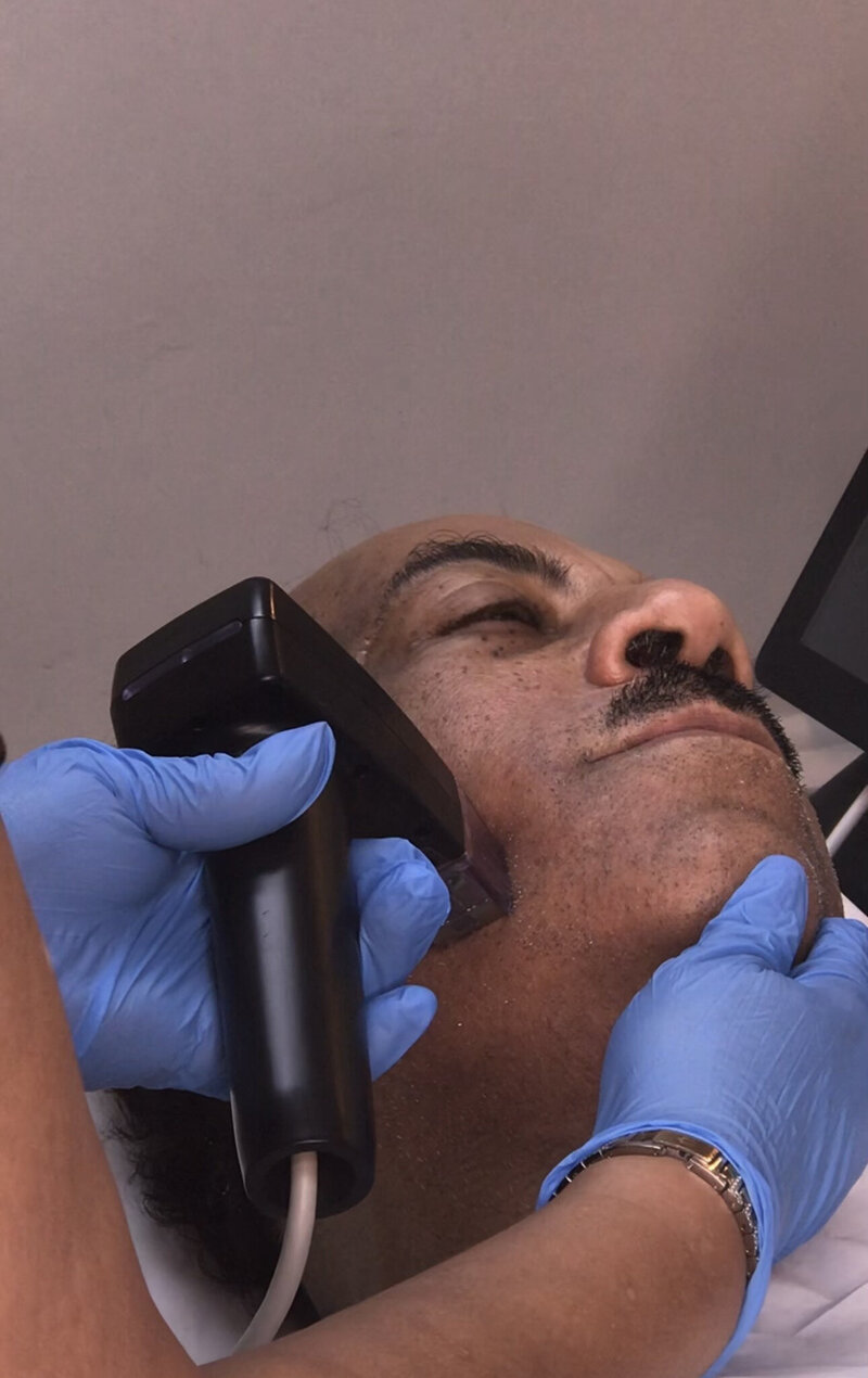 microneedling